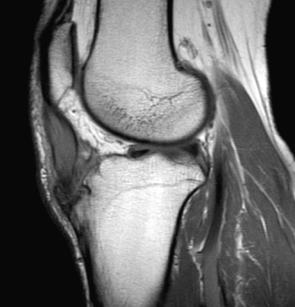 Figure 2 for case Intratenindous ganglion